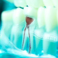 Closeup of a severely damaged tooth in a transparent jaw