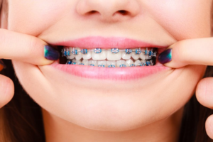 Woman holding lips back to show blue-banded braces